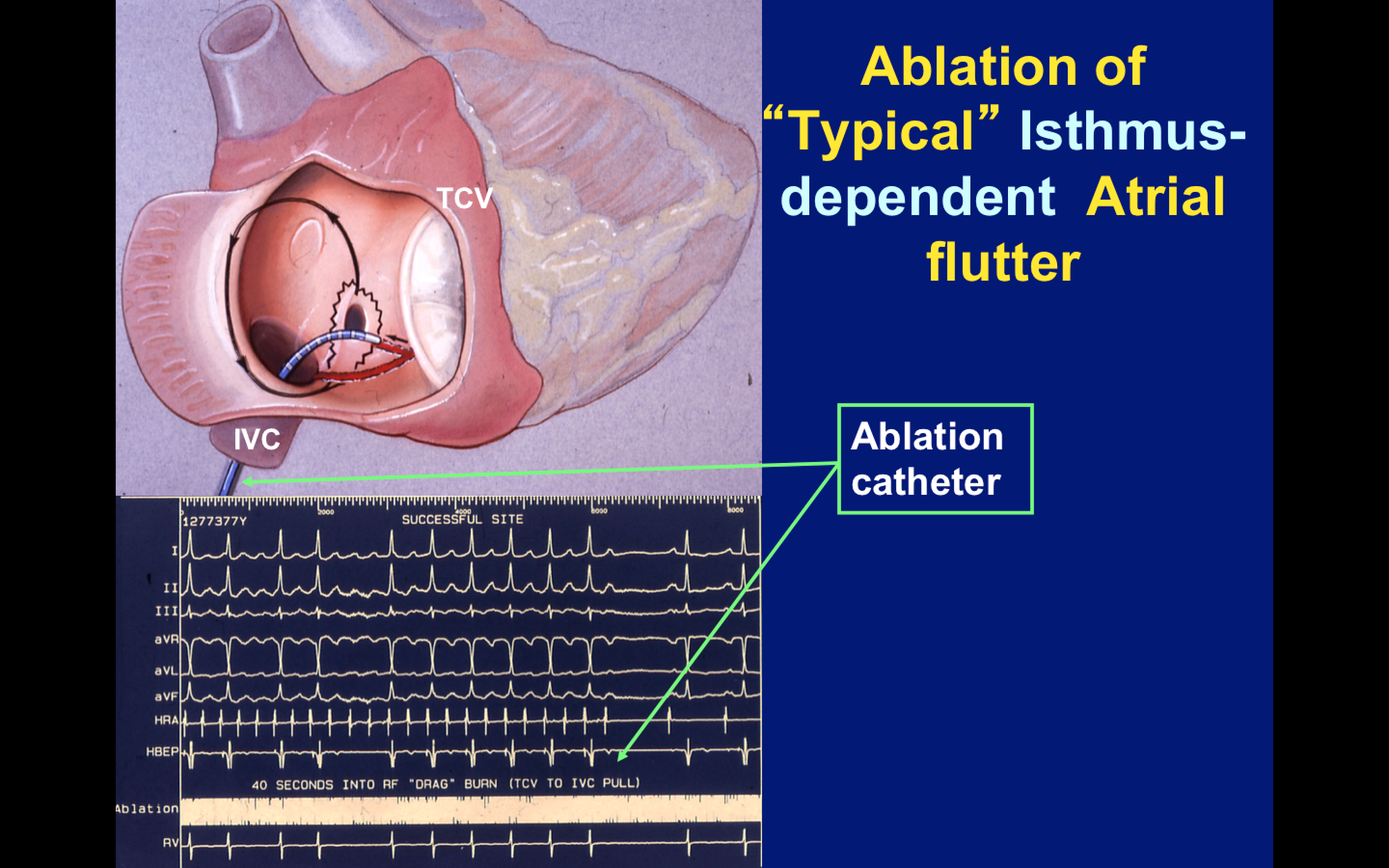 heart ablation for a flutter