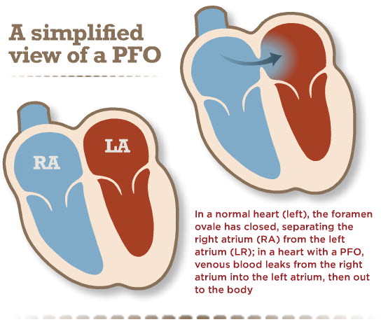 Young people, stroke and a hole in the heart (PFO) – Dr John M